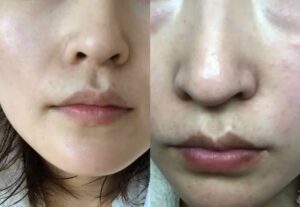 美顔器使用ビフォーアフター